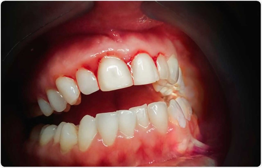 Bleeding Gums & Pyorrhea