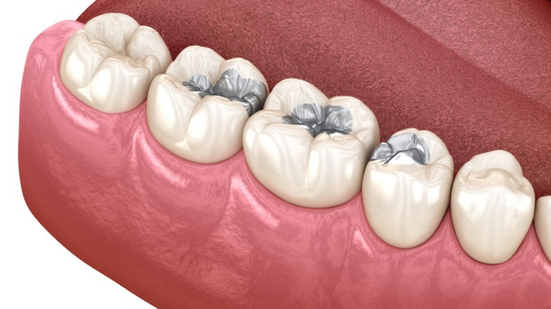Dental Fillings