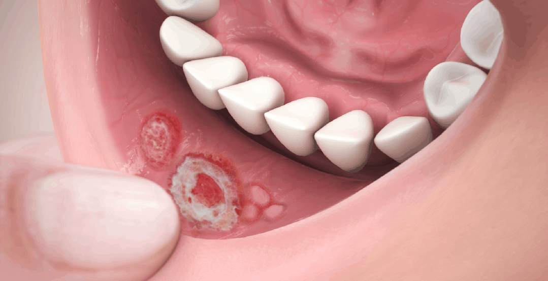 Mouth Ulcer Treatment