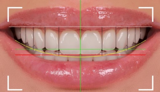 Smile Design