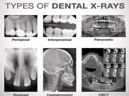 Dental X-rays & Diagnosis